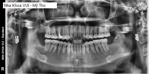 Hình ảnh Nha Khoa VUI - Mỹ Tho